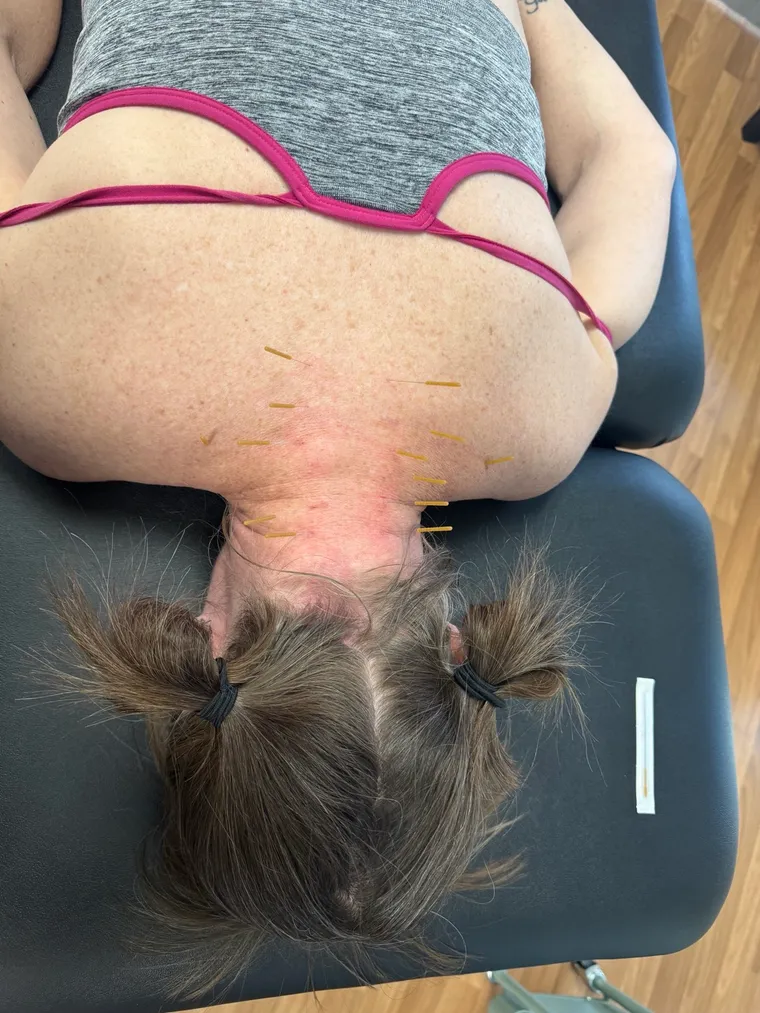 Dry needling treatment at Healing Hands Physical Therapy in Reno
